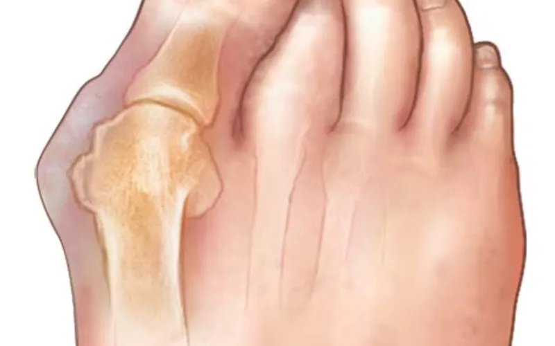 Bunion Treatment treatment at Bends Foot and Ankle in Chillicothe, Ohio