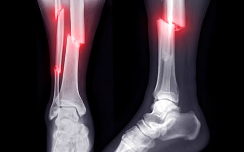 Two ankle x-rays with the fracture sites highlighted in red