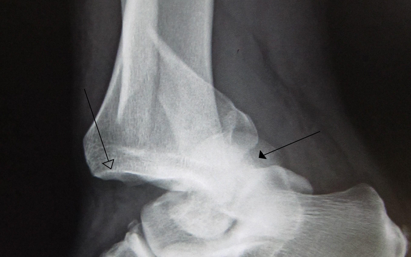 Foot and Ankle Dislocations
