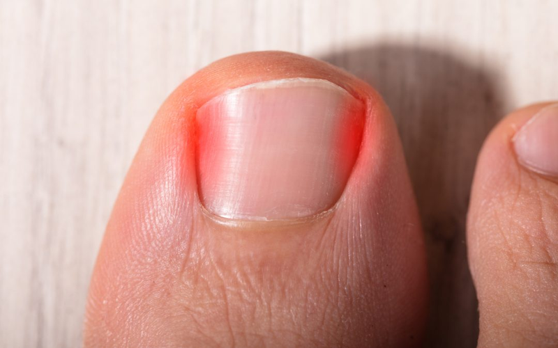 Ingrown Toenail Treatment